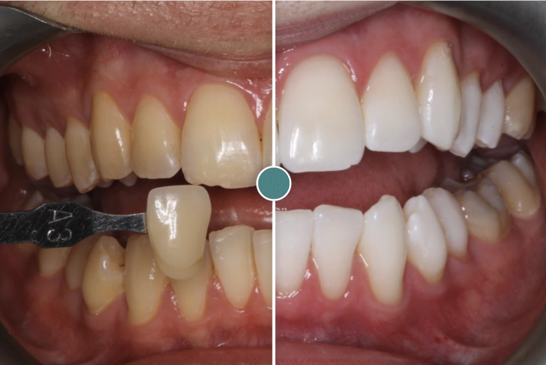 Teeth Whitening.