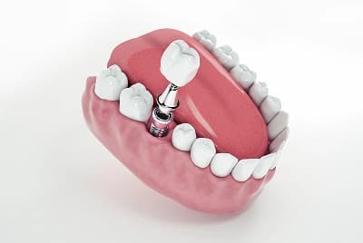 Dental Implants