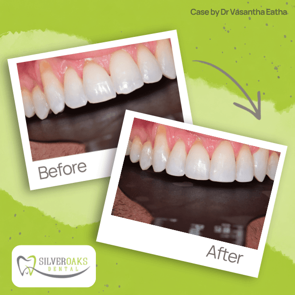 Smile case