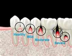 Peridontal Treatment